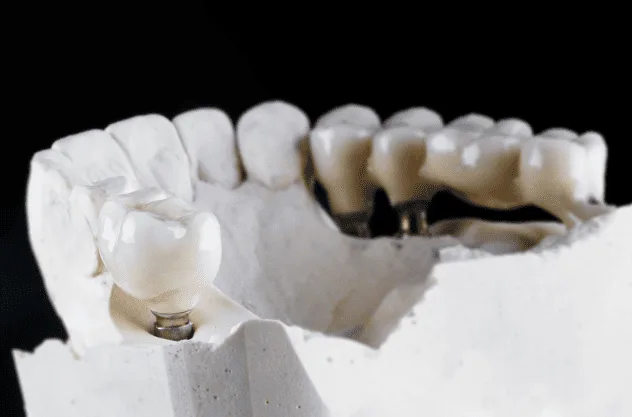 Crowns & Bridges at Diestel Dental Group, Hong Kong