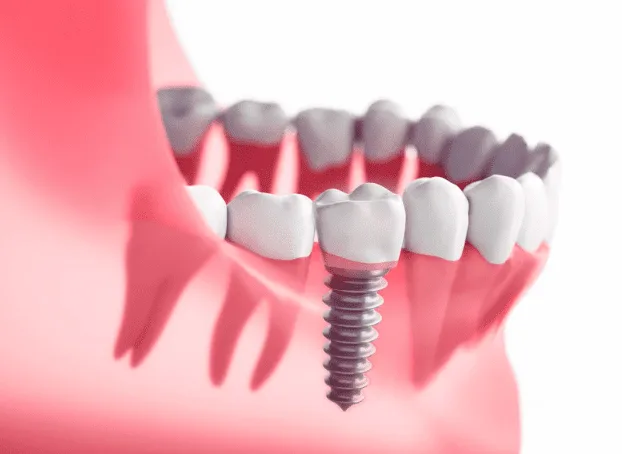 Dental Implants at Diestel Dental Group, Hong Kong