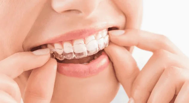 Invisalign at Diestel Dental Group, Hong Kong