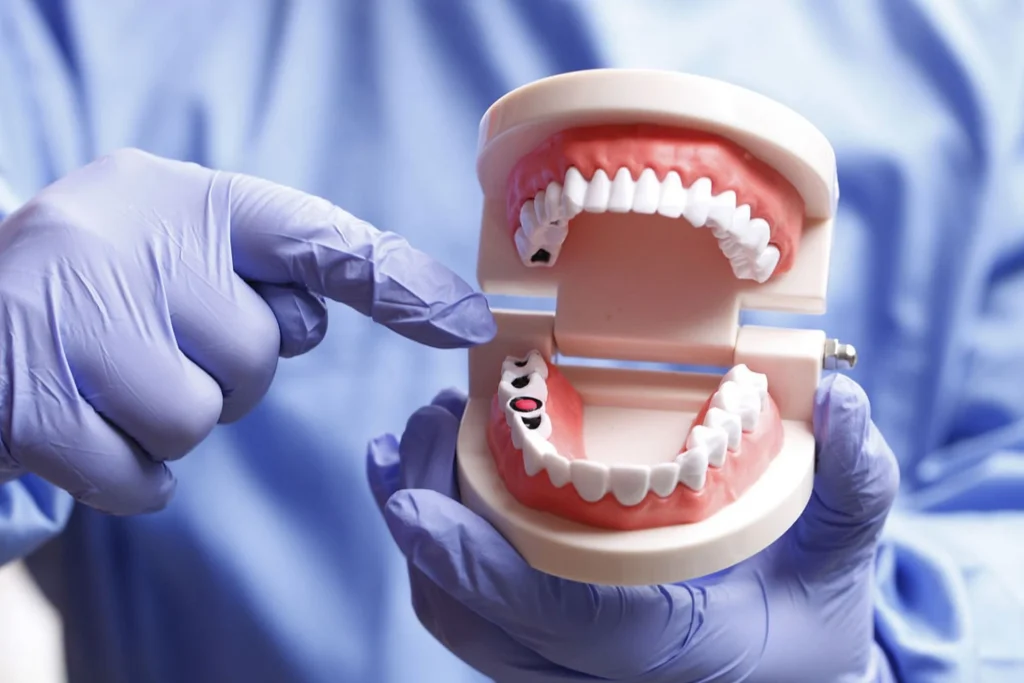 Gloved hands holding a dental model with visible tooth decay and cavities, a common oral cause of persistent bad breath