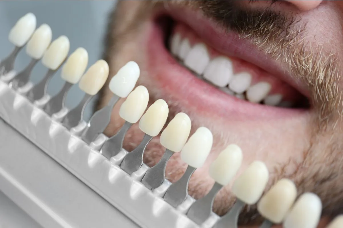 Veneers at Diestel Dental Group, Hong Kong