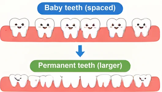 Spaces between baby teeth leave room for bigger adult teeth