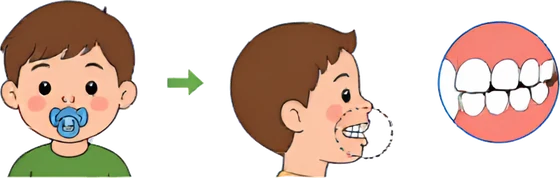 Long-term dummy use and how it can push the front teeth forward