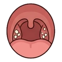 Tonsil stones at the back of the throat